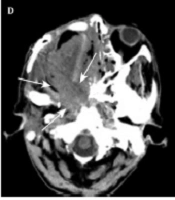 Clinical Outcomes of Intra-arterial Chemoradiotherapy and Neoadjuvant Chemoradiotherapy Followed by Surgery for Maxillary Sinus Squamous Cell Carcinoma