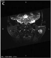 Three-Dimensional Sheath Inked Rapid Acquisition with Refocused Echoes Imaging (SHINKEI) MRI for Delineating the Intraparotid Facial Nerve Branches and Their Anatomical Relationship with Parotid Tumors