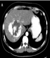 Treatment Benefits and Side Effects of Transarterial Chemoembolization with Drug-Eluting Bead Microspheres (DEB-TACE) in Hepatocellular Carcinoma Patients with Conventional TACE Resistance: A Retrospective Study