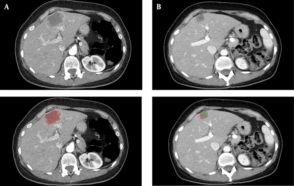 A, Patient with colorectal liver metastases before neoadjuvant chemotherapeutic treatment. B, The same patient after neoadjuvant chemotherapeutic treatment. A, Patient with colorectal liver metastases before neoadjuvant chemotherapeutic treatment. B, The same patient after neoadjuvant chemotherapeutic treatment.