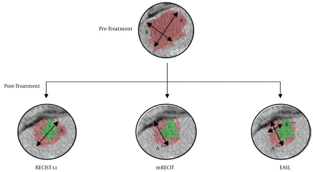 Calculation method for RECIST 1.1: A'/A × 100; Calculation method for mRECIST: A''/A × 100; Calculation method for EASL: (A'' × B'')/(A × B) × 100
Calculation method for RECIST 1.1: A'/A × 100; Calculation method for mRECIST: A''/A × 100; Calculation method for EASL: (A'' × B'')/(A × B) × 100