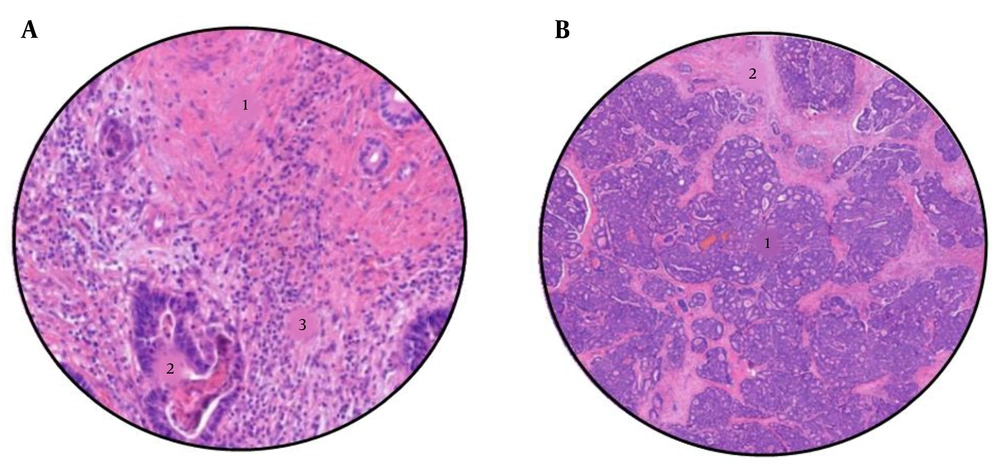 A, Sample from a colorectal liver metastases after neoadjuvant chemotherapy, with a tumour regression grade of 2 (TRG2). 1: Abundant fibrosis, 2: Few tumour cells, and 3: Lynphocytic infiltrate. B, Sample from a colorectal liver metastases after neoadjuvant chemotherapy, with a tumour regression grade of 5 (TRG5). 1: Abundant tumour cells, and 2: Areas of necrosis. A, Sample from a colorectal liver metastases after neoadjuvant chemotherapy, with a tumour regression grade of 2 (TRG2). 1: Abundant fibrosis, 2: Few tumour cells, and 3: Lynphocytic infiltrate. B, Sample from a colorectal liver metastases after neoadjuvant chemotherapy, with a tumour regression grade of 5 (TRG5). 1: Abundant tumour cells, and 2: Areas of necrosis.