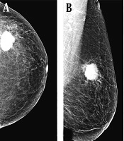 Tumor Size Measurements with Breast Magnetic Resonance Imaging (MRI) in Elderly Breast Cancer Patients: A Comparison of Breast MRI with Mammography and Ultrasound