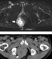 Perianal Metastasis of Small Cell Lung Carcinoma: A Case Report