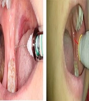 Intra-oral Ultrasonography of Young Adult Mandibular Foramen: A Reliable Method
