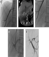 Use of Cone-Beam Computed Tomography (CBCT) for Targeting the Portal Vein in Transjugular Intrahepatic Portosystemic Shunt (TIPS) Procedures: Comparison of Low-Dose with Standard-Dose CBCT