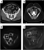 Can Diffusion-Weighted Imaging be a Gold Standard Method for Acute Appendicitis? A Comparative Study