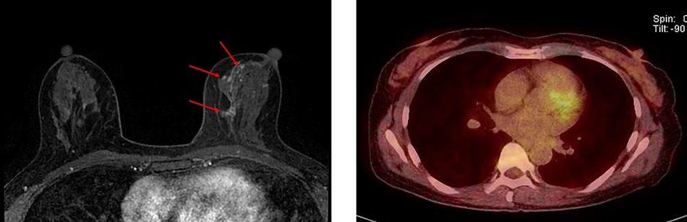 A 52-year-old woman with pure ductal carcinoma in situ (DCIS) in the left breast. A, Axial dynamic enhanced T1-weighted MRI demonstrates a segmental clumped non-mass enhancement (3.5 cm) (arrows) in the left middle inner part of the breast. B, The FDG-PET/CT scan shows no discernible FDG uptake in the left middle inner part of the breast. A 52-year-old woman with pure ductal carcinoma in situ (DCIS) in the left breast. A, Axial dynamic enhanced T1-weighted MRI demonstrates a segmental clumped non-mass enhancement (3.5 cm) (arrows) in the left middle inner part of the breast. B, The FDG-PET/CT scan shows no discernible FDG uptake in the left middle inner part of the breast.