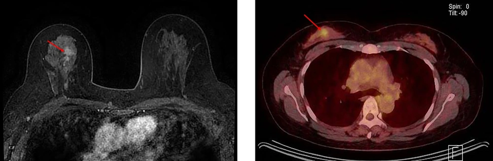 A 49-year-old woman with ductal carcinoma in situ (DCIS) upgraded to invasive ductal carcinoma (IDC) in the right breast. A, Axial dynamic enhanced T1-weighted MRI demonstrates a heterogeneously enhanced mass (2.1 cm) with an irregular shape and margins (arrow) in the right middle upper part of the breast. B, The FDG-PET/CT scan shows focal FDG uptake (arrow) in the right middle upper part of the breast with a maximum standardized uptake value (SUV<sub>max</sub>) of 2.9. A 49-year-old woman with ductal carcinoma in situ (DCIS) upgraded to invasive ductal carcinoma (IDC) in the right breast. A, Axial dynamic enhanced T1-weighted MRI demonstrates a heterogeneously enhanced mass (2.1 cm) with an irregular shape and margins (arrow) in the right middle upper part of the breast. B, The FDG-PET/CT scan shows focal FDG uptake (arrow) in the right middle upper part of the breast with a maximum standardized uptake value (SUV<sub>max</sub>) of 2.9.