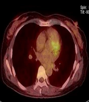 Role of FDG-PET/CT in Identification of Histological Upgrade of Ductal Carcinoma in Situ (DCIS) in Needle Biopsy