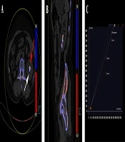 Characterization of Mixed Urinary Stone Compositions with Dual-Source Dual-Energy Computed Tomography in Vivo Compared to Infrared Spectroscopy