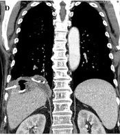 Successful Percutaneous Transhepatic Embolization of the Bronchobiliary Fistula Secondary to Biloma Using n-Butyl Cyanoacrylate and Microcoils