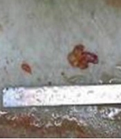 A Case of Swyer Syndrome Complicated with Left-sided Gonadoblastoma and Asexual Cell Tumor