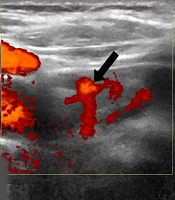 Cover image of the article: Combination Therapy of Ethanol Ablation and Radiofrequency Ablation to Treat Parathyroid Adenoma in a Case with Primary Hyperparathyroidism