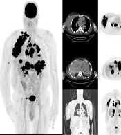 Association of Tumor Metabolic Activity on PET/CT Scan with Pathological Characteristics in Patients with Malignant Melanoma