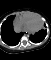 A Study of Fixed Current and Automatic Tube Current Modulation at a Fixed Low Tube Voltage in Low-dose Computed Tomography (CT) Imaging of Infant Lungs
