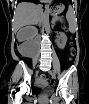 Necrotizing Fasciitis Extending to the Neck After Extracorporeal Shock Wave Lithotripsy: A Case Report
