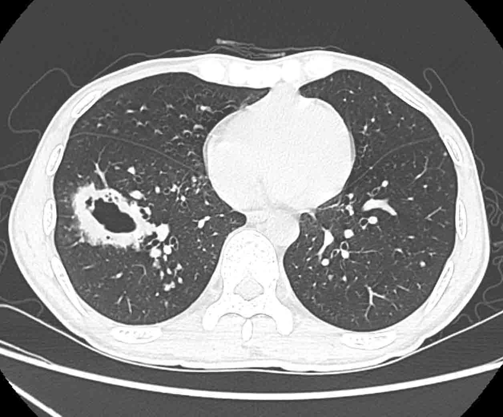 A 27-year-old HIV-infected man with pulmonary cryptococcosis (PC) and a representative thick-walled cavity lesion confirmed by pathology. In the right lower lobe, lesion with irregular thick-walled and line-shaped shadows had an unclear border with the normal lung, while small nodules with sharp borders mixed with ground-glass opacity around the cavity are detected. A 27-year-old HIV-infected man with pulmonary cryptococcosis (PC) and a representative thick-walled cavity lesion confirmed by pathology. In the right lower lobe, lesion with irregular thick-walled and line-shaped shadows had an unclear border with the normal lung, while small nodules with sharp borders mixed with ground-glass opacity around the cavity are detected.