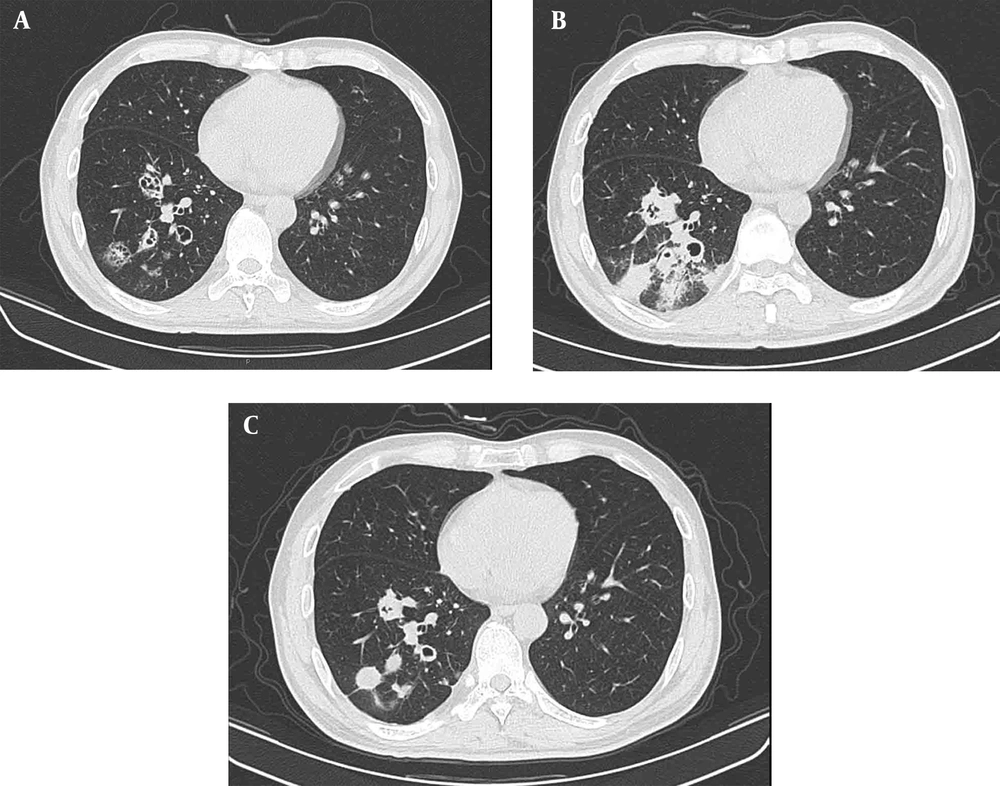 A-C, Pulmonary cryptococcosis (PC) in a 43-year-old man diagnosed with AIDS. CT scan (A) shows several cluster cavities in the right lower lobe, one of which is a cavity in wall (CW) lesion’, while others are thin-walled cavities with a CD4 cell count of 12/µL. Pulmonary lesions progressed to pneumonic infiltrates with ill-defined margins (B) two weeks after highly active antiretroviral therapy (HAART), with a CD4 cell count of 30/µL. In a review CT scan (C) after five months, cavities and consolidation had become solid nodules with clear borders with the normal lung, and the CD4 cell count in peripheral blood increased to 158/µL. A-C, Pulmonary cryptococcosis (PC) in a 43-year-old man diagnosed with AIDS. CT scan (A) shows several cluster cavities in the right lower lobe, one of which is a cavity in wall (CW) lesion’, while others are thin-walled cavities with a CD4 cell count of 12/µL. Pulmonary lesions progressed to pneumonic infiltrates with ill-defined margins (B) two weeks after highly active antiretroviral therapy (HAART), with a CD4 cell count of 30/µL. In a review CT scan (C) after five months, cavities and consolidation had become solid nodules with clear borders with the normal lung, and the CD4 cell count in peripheral blood increased to 158/µL.