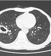 Correlation Between CD4 Cell Count, HIV Viral Load, and Chest CT Findings of AIDS-associated Pulmonary Cryptococcosis
