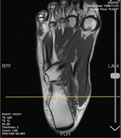 Intra- and Inter-rater Reliability of a Magnetic Resonance Imaging-Based Volumetric Analysis of the Abductor Hallucis Muscle