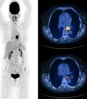 Cover image of the article: Value of a 18F-FDG PET/CT Semi-quantitative Parameter (SUVmax) in Predicting the Survival of Patients with Esophageal Cancer Subtypes