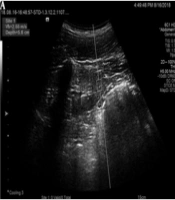 Efficacy of Virtual Touch Quantification Technique for Differentiating Patients with Immunoglobulin A Nephropathy (IgAN) from Healthy Controls