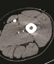 Clinical Feasibility of a Low-dose Computed Tomography Angiography Protocol with an Iterative Reconstruction Algorithm in Preoperative Examinations for Anterolateral Thigh Perforator Flap Surgery