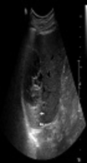 Cover image of the article: A Hepatic Cyst Complicated by Hemorrhage with Secondary Revascularization Mimicking Mucin-Producing Cystic Neoplasm: Radiologic-Pathologic Correlations