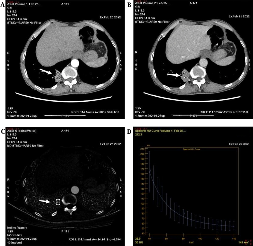A-D, A 58-year-old man with granulomatous inflammation of the right lower lung, indicated by a white arrows. A-B, A 70-keV single-energy image in the arteriovenous phase; a mass-like high-density shadow can be seen in the right lower lobe of the lung next to the spine with adjacent bronchial occlusion. C, Iodine map in the arteriovenous phase; the iodine concentration (IC) of the lesion in the arteriovenous phase is 14.26 μg/cm<sup>3</sup>. D, Arterial phase energy spectral graph. A-D, A 58-year-old man with granulomatous inflammation of the right lower lung, indicated by a white arrows. A-B, A 70-keV single-energy image in the arteriovenous phase; a mass-like high-density shadow can be seen in the right lower lobe of the lung next to the spine with adjacent bronchial occlusion. C, Iodine map in the arteriovenous phase; the iodine concentration (IC) of the lesion in the arteriovenous phase is 14.26 μg/cm<sup>3</sup>. D, Arterial phase energy spectral graph.