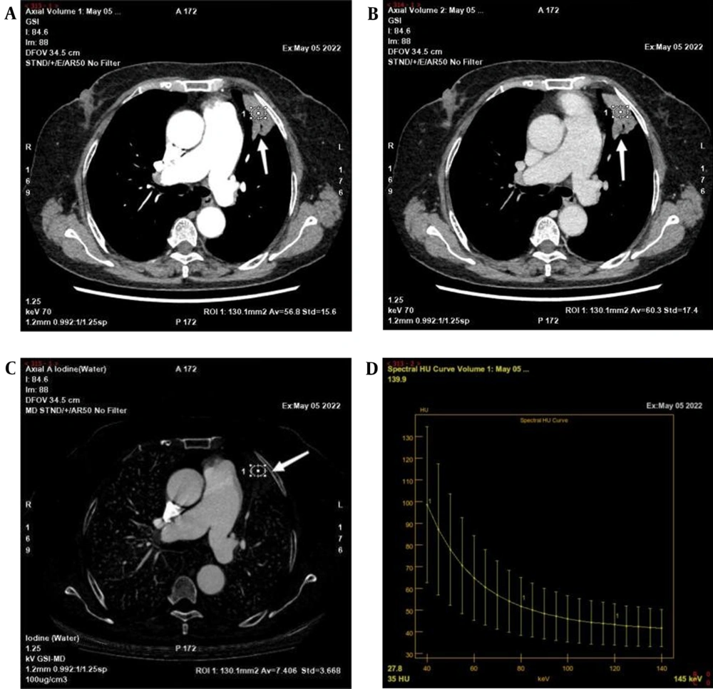 A-D, A 66-year-old man with adenocarcinoma of the left upper lung, indicated by a white arrows. A-B, A 70-keV single-energy image in the arteriovenous phase; a mass shadow of the left upper lobe of the lung can be seen with a cavity within it. C, An iodine base image in the arterial phase; the iodine concentration (IC) of the lesion in the arterial phase is 7.406 μg/cm<sup>3</sup>. D, Arterial phase energy spectral graph. A-D, A 66-year-old man with adenocarcinoma of the left upper lung, indicated by a white arrows. A-B, A 70-keV single-energy image in the arteriovenous phase; a mass shadow of the left upper lobe of the lung can be seen with a cavity within it. C, An iodine base image in the arterial phase; the iodine concentration (IC) of the lesion in the arterial phase is 7.406 μg/cm<sup>3</sup>. D, Arterial phase energy spectral graph.