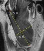 Cover image of the article: Correlation Between the Masticatory Muscle Dimensions and Internal Derangement of Temporomandibular Joints Based on Magnetic Resonance Imaging