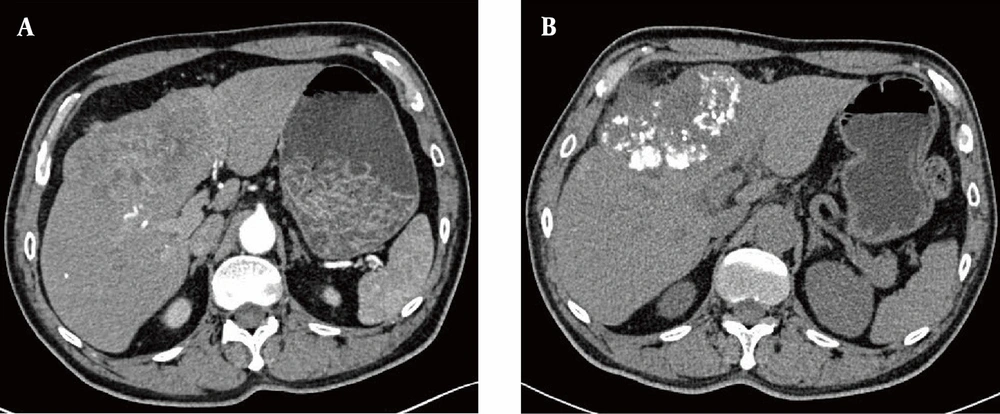 The computed tomography (CT) images before and after treatment. A, Axial CT scan after IV contrast medium injection in the arterial phase indicates hepatocellular carcinoma (HCC) located in the segment S4; B, Axial CT scan without IV contrast medium injection three months after transarterial chemoembolization (TACE), combined with anti-angiogenic therapy and immune checkpoint inhibitors (ICIs), indicates a reduced tumor volume and dense lipiodol deposition. The computed tomography (CT) images before and after treatment. A, Axial CT scan after IV contrast medium injection in the arterial phase indicates hepatocellular carcinoma (HCC) located in the segment S4; B, Axial CT scan without IV contrast medium injection three months after transarterial chemoembolization (TACE), combined with anti-angiogenic therapy and immune checkpoint inhibitors (ICIs), indicates a reduced tumor volume and dense lipiodol deposition.