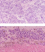 Subcutaneous Myoepithelial Carcinoma of the Ankle