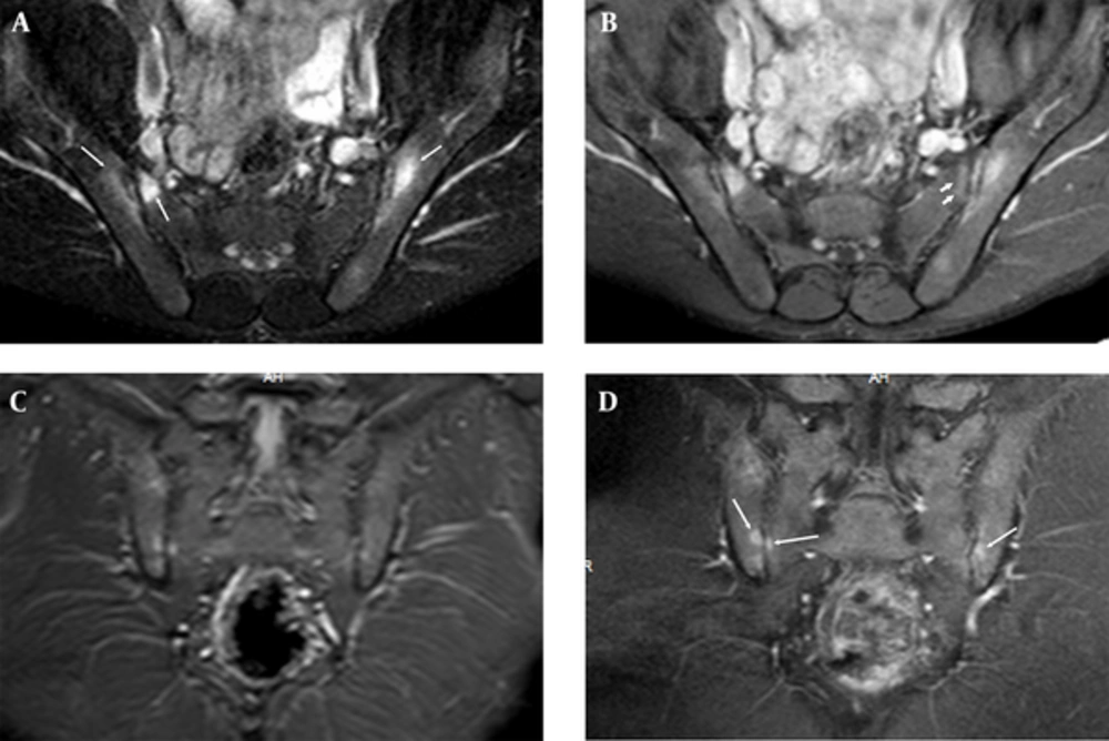 Sacroiliac MRI of a 30-year-old male patient who had normal CRP and ESR values and negative result for HLA B27, which shows osteitis. There is periarticular bone edema at bilateral iliac and right sacral bones (long arrows) on fat suppressed (FS) T2 weighted imaging (WI) (A); FS contrast enhanced (CE) T1 WI (B) of axial planes and STIR (C) and T1 WI of coronal planes (D). There is subchondral edema at left sacral bone on FS CE T1 WI (short arrows) (B, C). These periarticular bone edemas are compatible with osteitis. Sacroiliac MRI of a 30-year-old male patient who had normal CRP and ESR values and negative result for HLA B27, which shows osteitis. There is periarticular bone edema at bilateral iliac and right sacral bones (long arrows) on fat suppressed (FS) T2 weighted imaging (WI) (A); FS contrast enhanced (CE) T1 WI (B) of axial planes and STIR (C) and T1 WI of coronal planes (D). There is subchondral edema at left sacral bone on FS CE T1 WI (short arrows) (B, C). These periarticular bone edemas are compatible with osteitis.