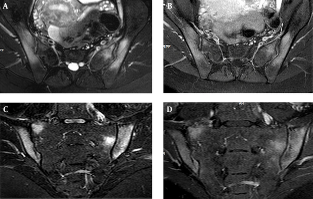 Edema of both sacral and iliac bones, compatible with osteitis are shown on FS T2 weighted (A) and CE T1 weighted (B) image of axial planes in a 25-year-old female with elevated CRP and ESR values and positive result for HLA B27. STIR (short tau inversion recovery) (C) and FS CE (fat suppressed contrast enhanced) T1 weighted (D) images of coronal plane show the same findings. Left Anterior capsulitis (arrow) is seen on FS T2 W (A) and CE T1 W (B) image of axial planes. Edema of both sacral and iliac bones, compatible with osteitis are shown on FS T2 weighted (A) and CE T1 weighted (B) image of axial planes in a 25-year-old female with elevated CRP and ESR values and positive result for HLA B27. STIR (short tau inversion recovery) (C) and FS CE (fat suppressed contrast enhanced) T1 weighted (D) images of coronal plane show the same findings. Left Anterior capsulitis (arrow) is seen on FS T2 W (A) and CE T1 W (B) image of axial planes.
