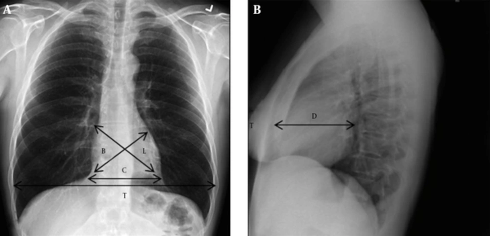 The measurements of cardiothoracic ratio, cardiac area, and cardiac volume are shown on posteroanterior (A) and lateral (B) chest X-Rays. B, from the right cardiophrenic angle to the base of the main pulmonary artery segment; D, the greatest cardiac diameter on the lateral film; and L, from the junction of the right atrium and superior vena cava to the apex. Abbreviations: CA, cardiac area; CV, cardiac volume: CV = L × B × D × K. The measurements of cardiothoracic ratio, cardiac area, and cardiac volume are shown on posteroanterior (A) and lateral (B) chest X-Rays. B, from the right cardiophrenic angle to the base of the main pulmonary artery segment; D, the greatest cardiac diameter on the lateral film; and L, from the junction of the right atrium and superior vena cava to the apex. Abbreviations: CA, cardiac area; CV, cardiac volume: CV = L × B × D × K.