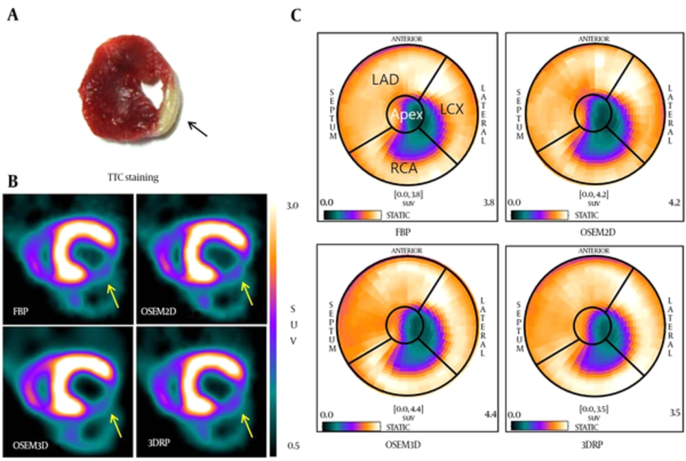 Infarct locations in TTC image (A), short-axis PET images (B), and polar map images (C) reconstructed by the FBP, OSEM2D, OSE3D, and 3DRP algorithms. (Abbreviations: PET; positron emission tomography, FBP; filtered back-projection, 3DRP; three dimensional reprojection algorithm, OSEM2D, two-dimensional ordered subsets expectation maximization; OSEM3D, three-dimensional ordered subsets expectation maximization, TTC; 2,3,5-triphenyltetrazolium chloride). Infarct locations in TTC image (A), short-axis PET images (B), and polar map images (C) reconstructed by the FBP, OSEM2D, OSE3D, and 3DRP algorithms. (Abbreviations: PET; positron emission tomography, FBP; filtered back-projection, 3DRP; three dimensional reprojection algorithm, OSEM2D, two-dimensional ordered subsets expectation maximization; OSEM3D, three-dimensional ordered subsets expectation maximization, TTC; 2,3,5-triphenyltetrazolium chloride).