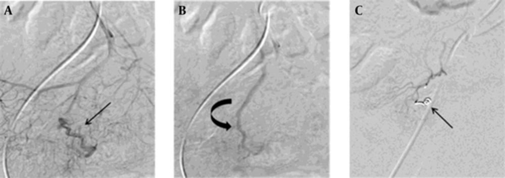 Successful microcoil embolization in a 72-year-old woman with angiodysplasia. A and B, Selective superior mesenteric angiogram showing a tortuous arterial supply (straight arrow) and an early draining vein (curved arrow) without evident nidus in the distal ileum. These findings suggest angiodysplasia. C, After microcoil embolization of the tortuous artery (arrow), no evidence of contrast filling was observed in the angiodysplasia. Successful microcoil embolization in a 72-year-old woman with angiodysplasia. A and B, Selective superior mesenteric angiogram showing a tortuous arterial supply (straight arrow) and an early draining vein (curved arrow) without evident nidus in the distal ileum. These findings suggest angiodysplasia. C, After microcoil embolization of the tortuous artery (arrow), no evidence of contrast filling was observed in the angiodysplasia.