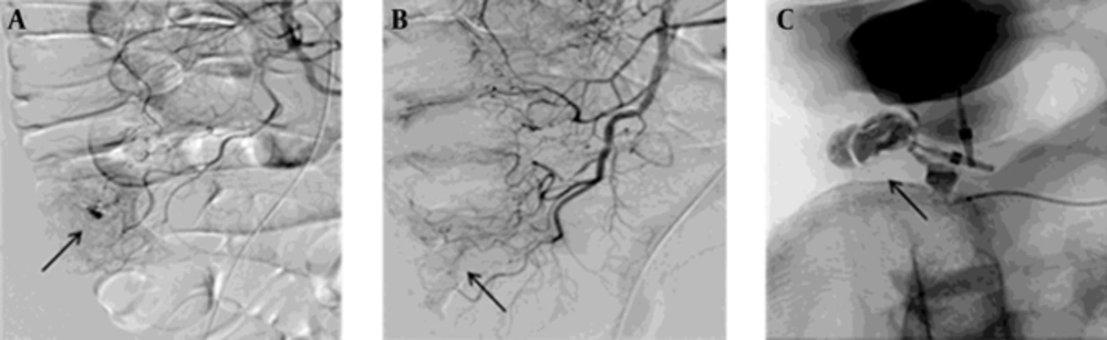 Successful glue embolization in a 54-year-old man with cecal diverticulum. A, Selective superior mesenteric arteriography representing contrast extravasation (arrow) in the distal ileocolic artery. B, Embolization of the distal vasa recta was performed using radiopaque glue (histoacryl, arrow). C, A postembolization angiogram showing hemostasis and packing of the radiopaque glue (arrow). Successful glue embolization in a 54-year-old man with cecal diverticulum. A, Selective superior mesenteric arteriography representing contrast extravasation (arrow) in the distal ileocolic artery. B, Embolization of the distal vasa recta was performed using radiopaque glue (histoacryl, arrow). C, A postembolization angiogram showing hemostasis and packing of the radiopaque glue (arrow).