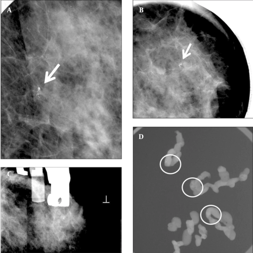 A 55-year-old woman with abnormal left mammogram categorized as 4a. A and B, Left craniocaudal magnification and mediolateral oblique magnification view showed suspicious clustered microcalcifications in the outer breast (arrow). C, Stereotactic biopsy was done. D, Specimen radiography of some samples from an 8 gauge biopsy showed multiple microcalcifications (circled). Pathology of biopsy revealed ductal carcinoma in situ. The imaging and histologic finding was considered concordant. Subsequent surgery was done. Pathologist confirmed no residual malignancy. A 55-year-old woman with abnormal left mammogram categorized as 4a. A and B, Left craniocaudal magnification and mediolateral oblique magnification view showed suspicious clustered microcalcifications in the outer breast (arrow). C, Stereotactic biopsy was done. D, Specimen radiography of some samples from an 8 gauge biopsy showed multiple microcalcifications (circled). Pathology of biopsy revealed ductal carcinoma in situ. The imaging and histologic finding was considered concordant. Subsequent surgery was done. Pathologist confirmed no residual malignancy.