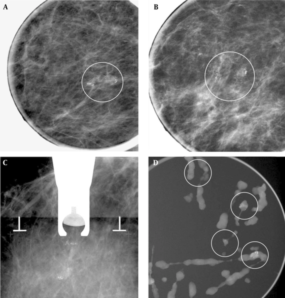 A 62-year-old woman with right mammogram categorized as 4b. A and B, Right craniocaudal magnificantion and mediolateral oblique magnificantion view showed suspicious clustered microcalcifiecation (circled). C, Stereotatic biopsy was done. D, Specimen radiography of some samples from an 8 gauge biopsy showed enough sampling of microcalfication (circled). Pathology of biopsy revealed fibrocystic disease with microcalcifications. Imaging-histologic correlation was considered discordant. Subsequent surgery was planned, but follow-up mammography was performed due to patient’s refuse. There was no interval change occurred on follow up mammography and spot magnification view at least 2 years and regarded as benign. A 62-year-old woman with right mammogram categorized as 4b. A and B, Right craniocaudal magnificantion and mediolateral oblique magnificantion view showed suspicious clustered microcalcifiecation (circled). C, Stereotatic biopsy was done. D, Specimen radiography of some samples from an 8 gauge biopsy showed enough sampling of microcalfication (circled). Pathology of biopsy revealed fibrocystic disease with microcalcifications. Imaging-histologic correlation was considered discordant. Subsequent surgery was planned, but follow-up mammography was performed due to patient’s refuse. There was no interval change occurred on follow up mammography and spot magnification view at least 2 years and regarded as benign.