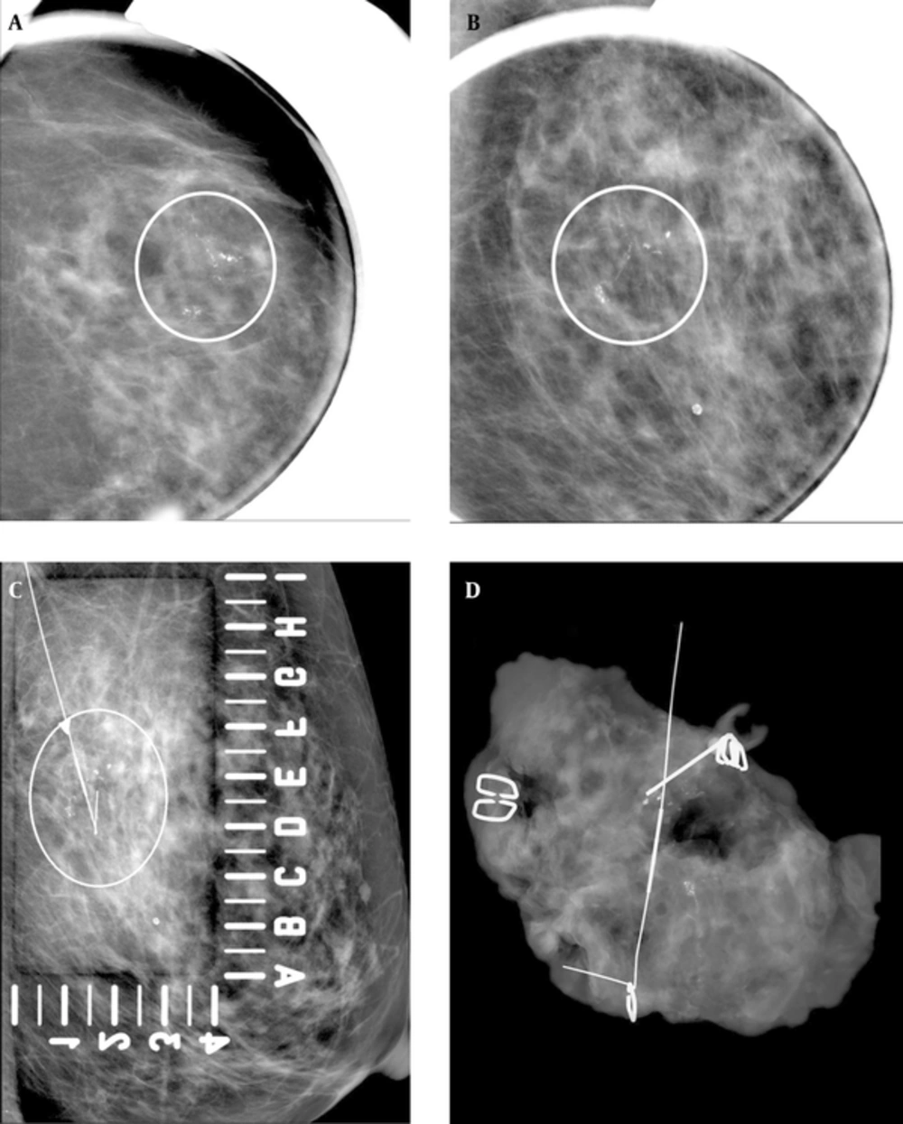 A 69-year-old woman with abnormal left mammogram categorized as 4c. A and B, Craniocaudal magnification and mediolateral oblique magnification view showed suspicious segmental fine linear and branching microcalcifications (circled). C, Mammography-guided needle localization was performed (circled). D, Specimen radiography of surgical specimen revealed adequate sampling of microcalcifications. Pathology of biopsy revealed DCIS. The imaging and histologic finding was considered concordant. A 69-year-old woman with abnormal left mammogram categorized as 4c. A and B, Craniocaudal magnification and mediolateral oblique magnification view showed suspicious segmental fine linear and branching microcalcifications (circled). C, Mammography-guided needle localization was performed (circled). D, Specimen radiography of surgical specimen revealed adequate sampling of microcalcifications. Pathology of biopsy revealed DCIS. The imaging and histologic finding was considered concordant.