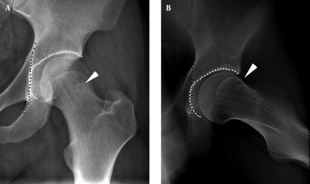 A 31 year old male with left groin pain for 2 years. A, Conventional radiograph shows a round lucency in the femoral neck (arrowhead), and acetabular fossa (white dotted line) touching the ilioischial line (black dotted line), which refers to coxa profunda; B, Digital tomosynthesis at special functional position (DT-SFP) image shows an oval lucency in the anterosuperior femoral neck (arrowhead), just corresponding to the outer edge of the acetabulum, and a coxa profunda (black and white dotted line). A 31 year old male with left groin pain for 2 years. A, Conventional radiograph shows a round lucency in the femoral neck (arrowhead), and acetabular fossa (white dotted line) touching the ilioischial line (black dotted line), which refers to coxa profunda; B, Digital tomosynthesis at special functional position (DT-SFP) image shows an oval lucency in the anterosuperior femoral neck (arrowhead), just corresponding to the outer edge of the acetabulum, and a coxa profunda (black and white dotted line).
