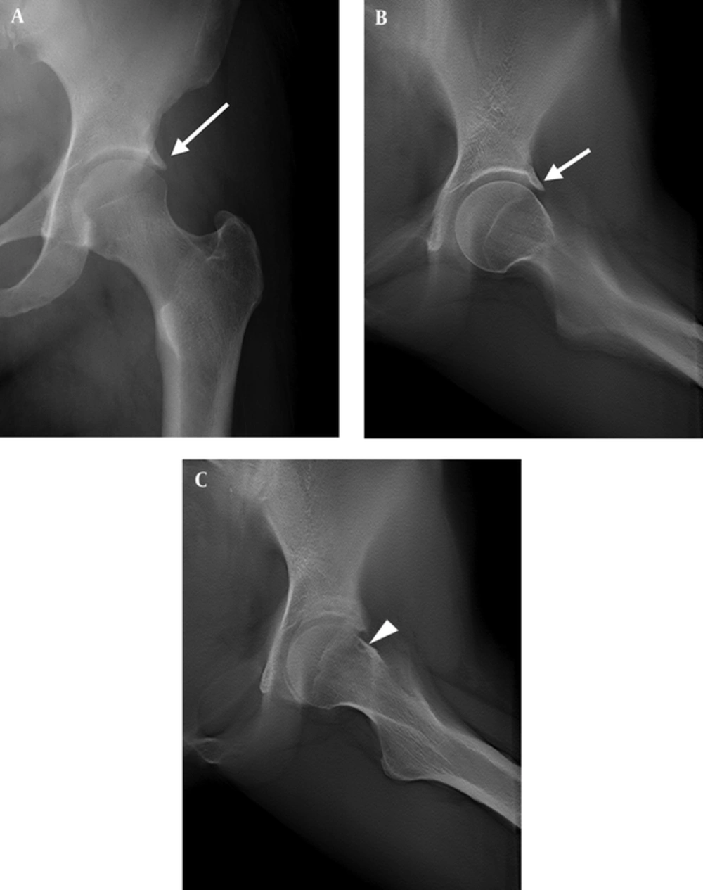 A 55-year-old female with left groin pain for 1.5 years after long distance walking. A, Conventional radiograph shows coxa profunda and acetabular osteophytes (long arrow) with a sharp edge, and pincer-like deformity; B and C, Digital tomosynthesis at special functional position (DT-SFP) images show sharp osteophytes in the rim of the acetabulum (short arrow) and coxa profunda. Herniation pit is not shown on the conventional radiograph it is clear on DT-SFP located in the junction of the femoral head and neck (arrow head). A 55-year-old female with left groin pain for 1.5 years after long distance walking. A, Conventional radiograph shows coxa profunda and acetabular osteophytes (long arrow) with a sharp edge, and pincer-like deformity; B and C, Digital tomosynthesis at special functional position (DT-SFP) images show sharp osteophytes in the rim of the acetabulum (short arrow) and coxa profunda. Herniation pit is not shown on the conventional radiograph it is clear on DT-SFP located in the junction of the femoral head and neck (arrow head).