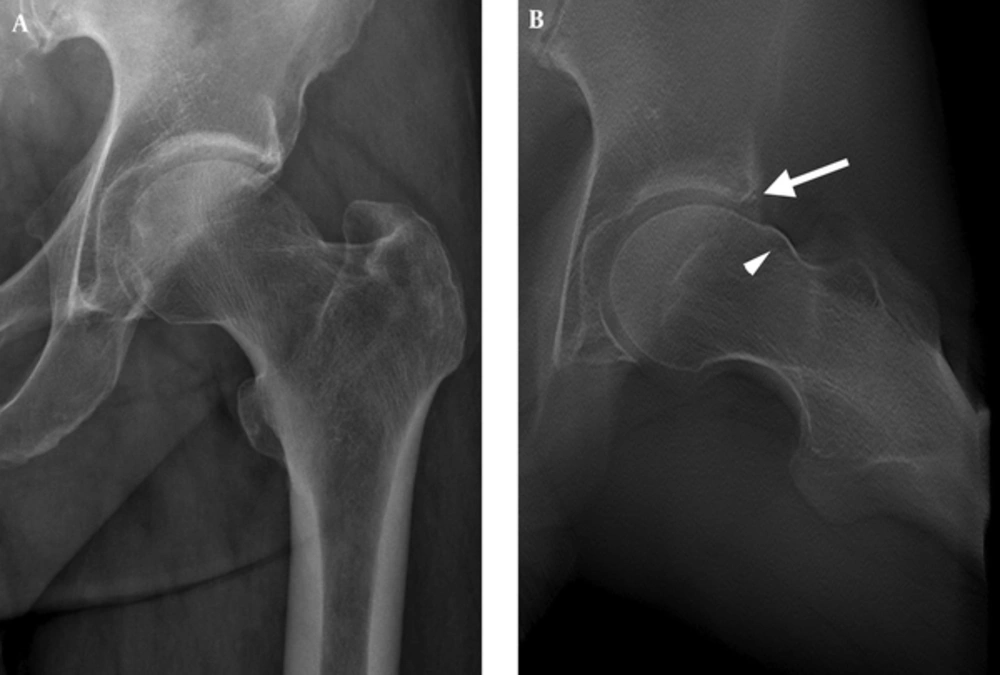 A 37-year-old male with left hip pain for eight months. A, Conventional radiograph shows an aspherical femoral head; B, Digital tomosynthesis at special functional position (DT-SFP) shows bony protrusion at the femoral head-neck junction (arrowhead) and a small acetabular labrum ossification (arrow). A 37-year-old male with left hip pain for eight months. A, Conventional radiograph shows an aspherical femoral head; B, Digital tomosynthesis at special functional position (DT-SFP) shows bony protrusion at the femoral head-neck junction (arrowhead) and a small acetabular labrum ossification (arrow).