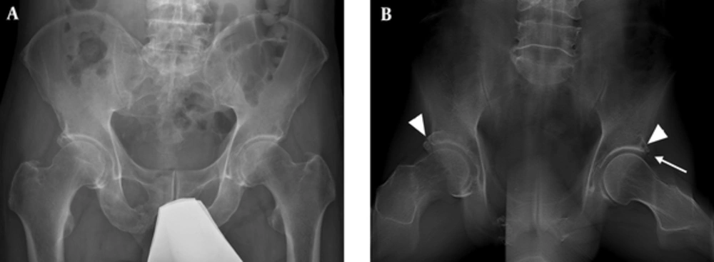 A 43-year-old male with bilateral groin pain for 5 years. A, Conventional radiograph does not show any obvious abnormality; B, Digital tomosynthesis at special functional position (DT-SFP) shows a prominent separated acetabular labrum ossification at the right acetabulum (arrowhead) and a cyst located at the junction of the head and neck in the area contacting with the acetabulum rim (arrowhead) and a very small ossification of labral basis (arrow). A 43-year-old male with bilateral groin pain for 5 years. A, Conventional radiograph does not show any obvious abnormality; B, Digital tomosynthesis at special functional position (DT-SFP) shows a prominent separated acetabular labrum ossification at the right acetabulum (arrowhead) and a cyst located at the junction of the head and neck in the area contacting with the acetabulum rim (arrowhead) and a very small ossification of labral basis (arrow).