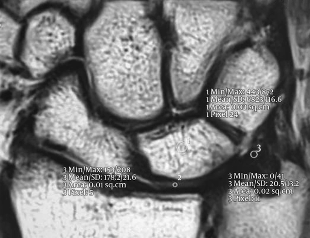 2D T2BLADE MR image demonstrating examples of region of interest (ROI) on the disc of the triangular fibrocartilage complex (TFCC) 2D T2BLADE MR image demonstrating examples of region of interest (ROI) on the disc of the triangular fibrocartilage complex (TFCC)