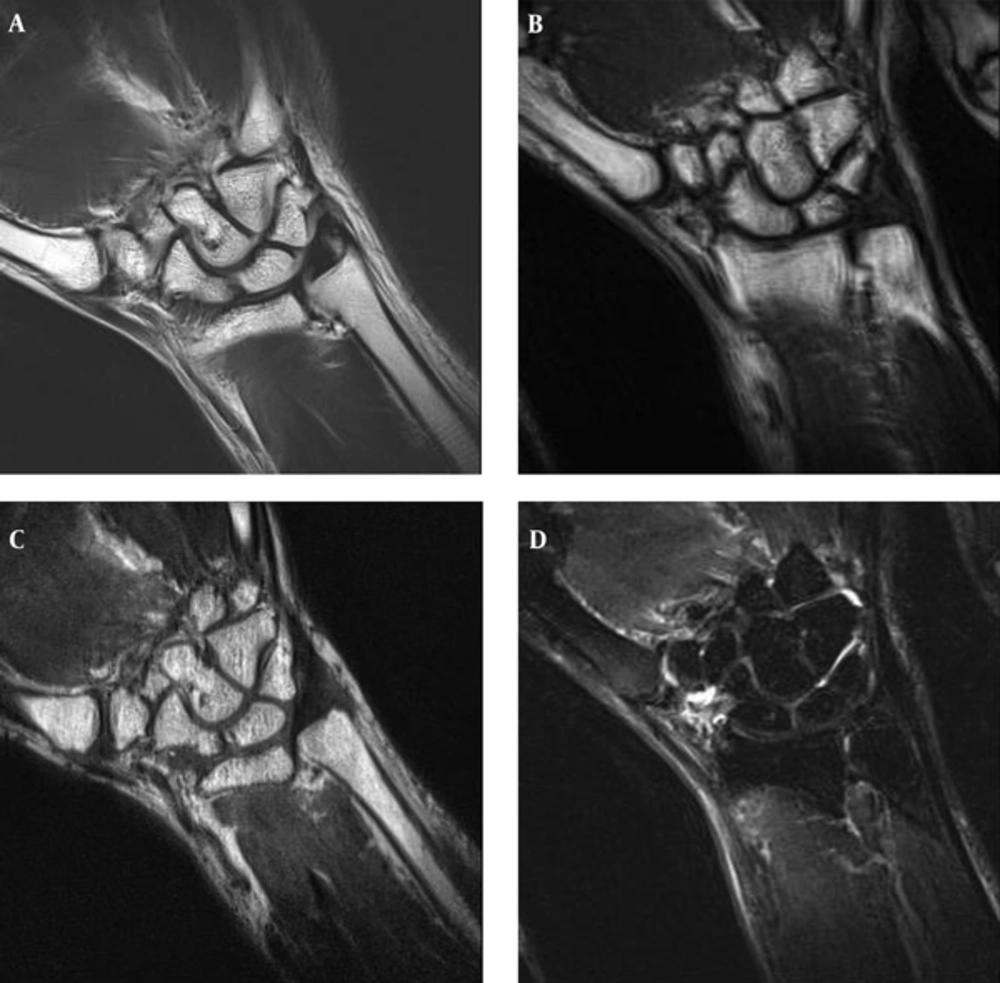 A, Coronal PD BLADE; B, T1 F; C, 3D SPACE; D, T2 FSE FS images of the wrist. PD BLADE image eliminates the motion artifact and improves image quality compared to T1 F, 3D SPACE, and T2 FSE FS. A, Coronal PD BLADE; B, T1 F; C, 3D SPACE; D, T2 FSE FS images of the wrist. PD BLADE image eliminates the motion artifact and improves image quality compared to T1 F, 3D SPACE, and T2 FSE FS.