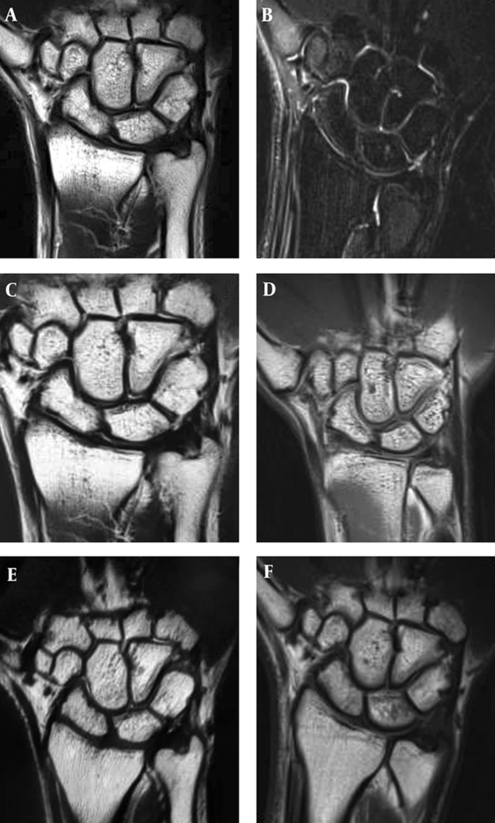 A, Coronal T2 BLADE; B, T2 FSE FS; C, PD BLADE; D, PD FSE; E, 3D T2 SPACE; and F, T1 FSE images demonstrate anatomical structure of the wrist A, Coronal T2 BLADE; B, T2 FSE FS; C, PD BLADE; D, PD FSE; E, 3D T2 SPACE; and F, T1 FSE images demonstrate anatomical structure of the wrist